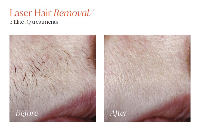 Laser Hair Removal 2