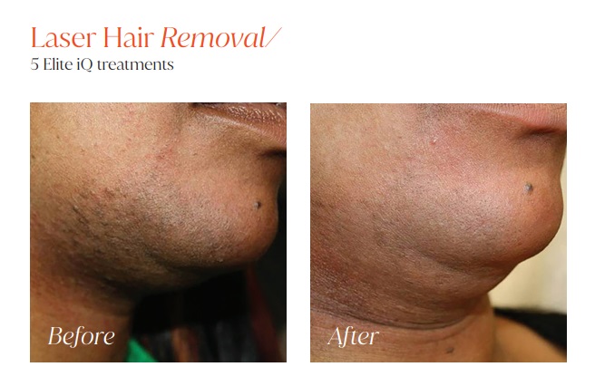Laser Hair Removal 4