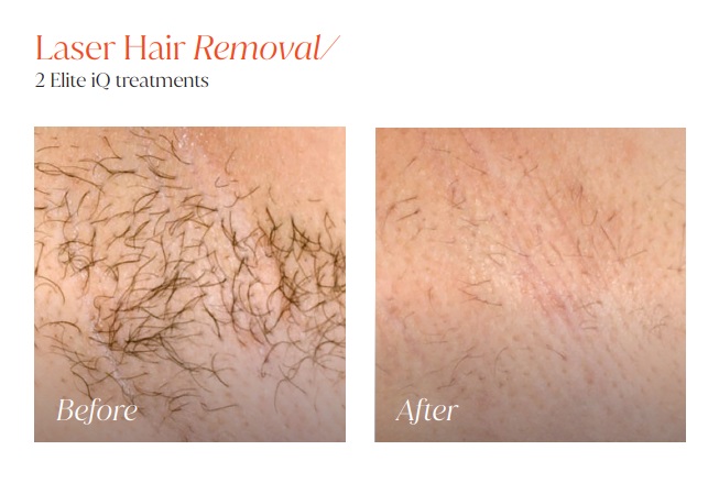 Laser Hair Removal 5